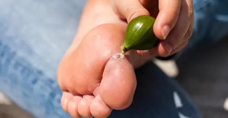 Природен лек изсмуква кокошия трън за нула време и без болка