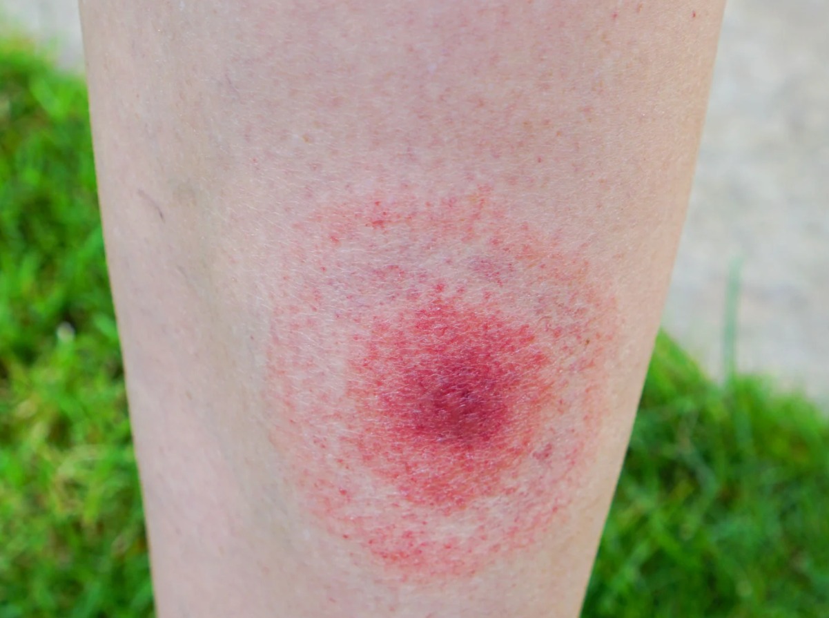 Коварна зараза плъзна с пълна сила в България