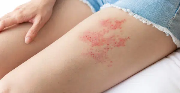shingles zona.png