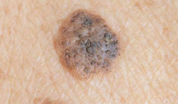 Seborrheic Keratosis vs Melanoma Blog 600x350 1