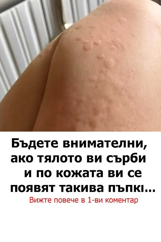 Бъдете внимателни, ако тялото ви сърби и по кожата ви се появят такива пъпки…