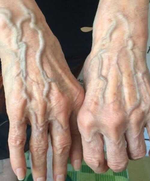 Ако имате видими вени, това означава, че сте… Вижте повече