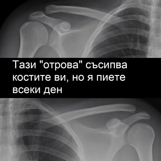 Тази „отрова“ вреди на костите ви – а вие я пиете всеки ден!