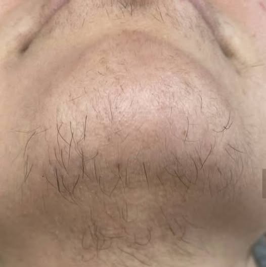 Ако сте жена и забелязвате поява на косъмчета по брадичката, това означава, че сте…