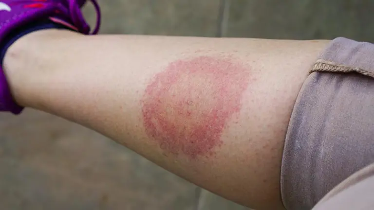 Бъдете нащрек! Коварна зараза плъзна с пълна сила в България