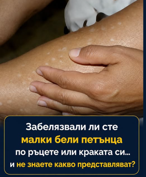 Ако имате бели петна по кожата си, това означава, че сте…